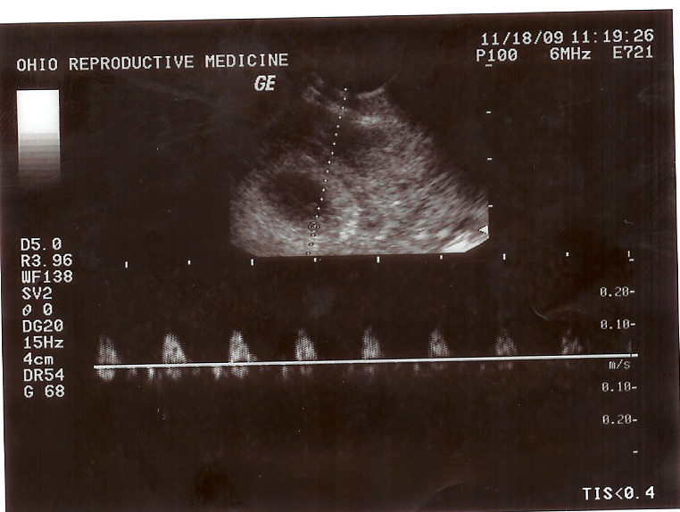 baby's heart beat