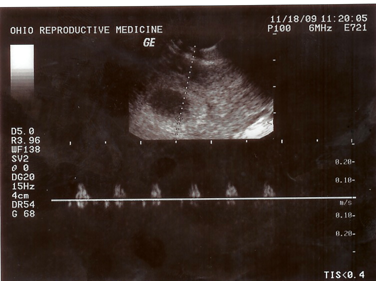 another baby heart beat
