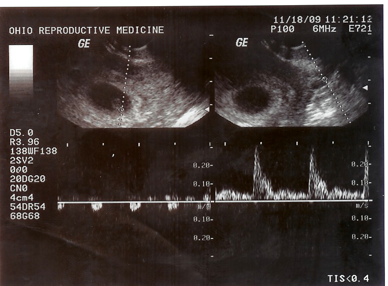 comparison of meridith's heart beat to baby's